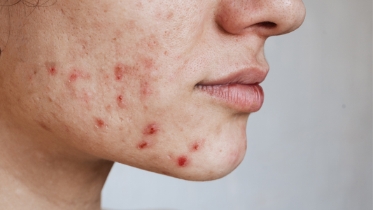 Een close up van een vrouw met acne in het gezicht.